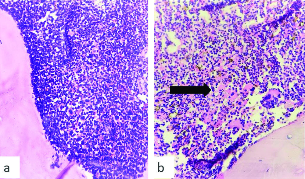 Hypercellular Polycythemia Vera (PV)- Hypercellular marrow with panmyelosis and ...