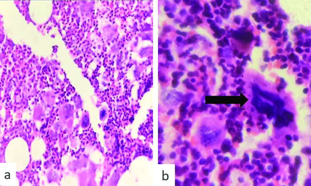 Hypercellular Prefibrotic Myelofibrosis (PMF) - Hypercellular marrow with increased ...