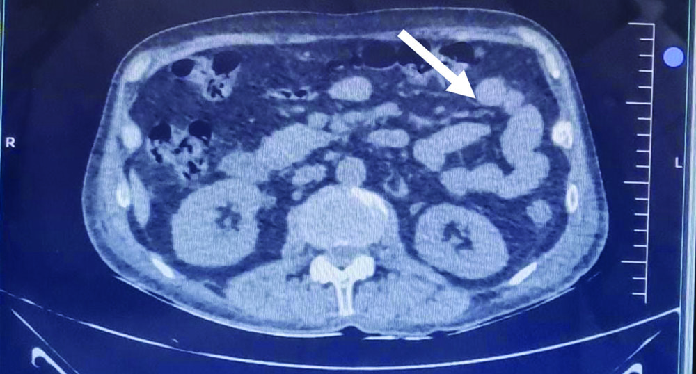 Pyelo Fat Stranding Non-contrast Computed Tomography (CT) of the Abdomen (arrows show ...