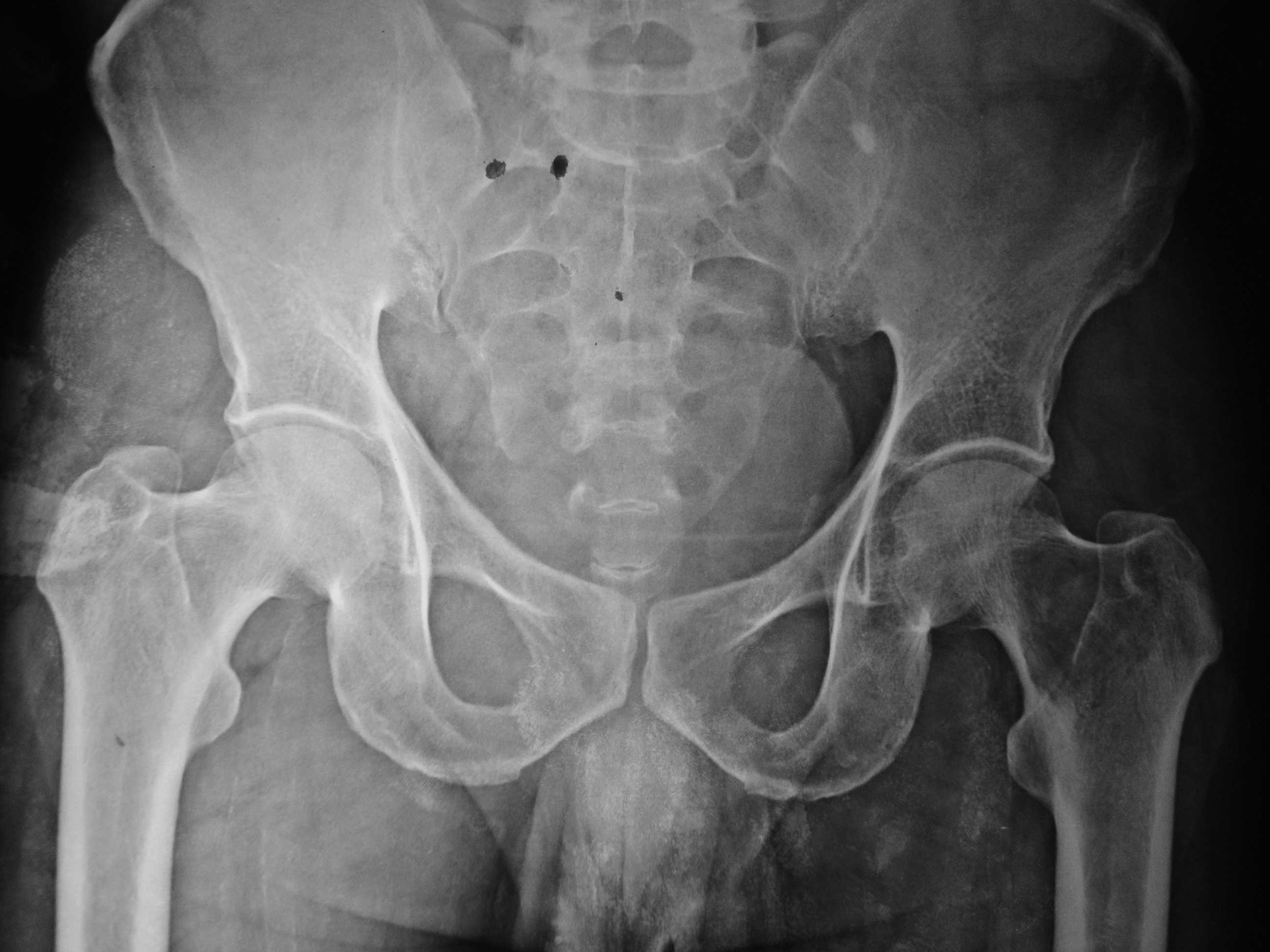 normal hip xray review
