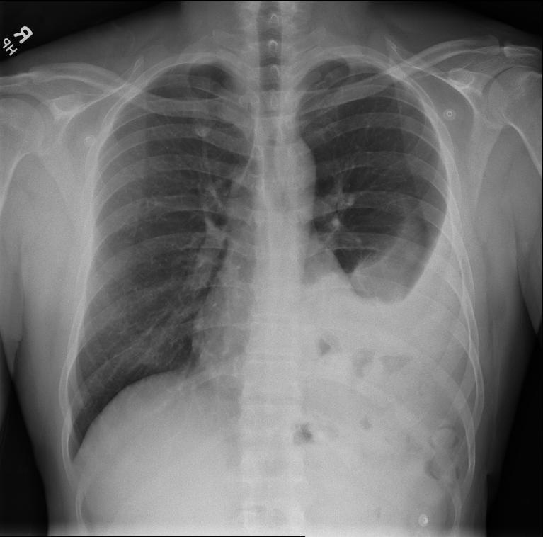 Traumatic Diaphragmatic Hernia