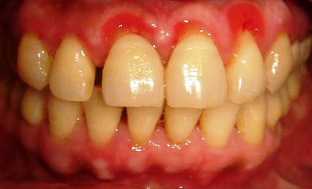 Exostosis Teeth