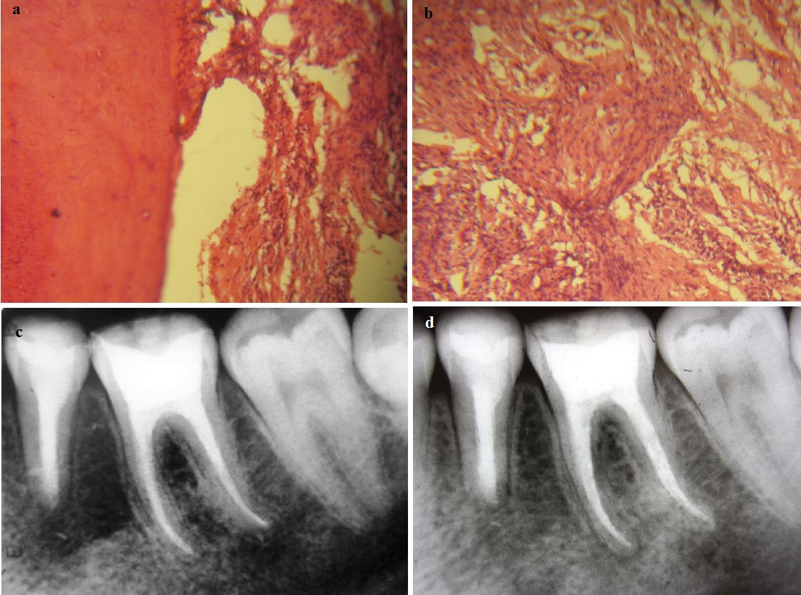 Periapical Cyst Histology