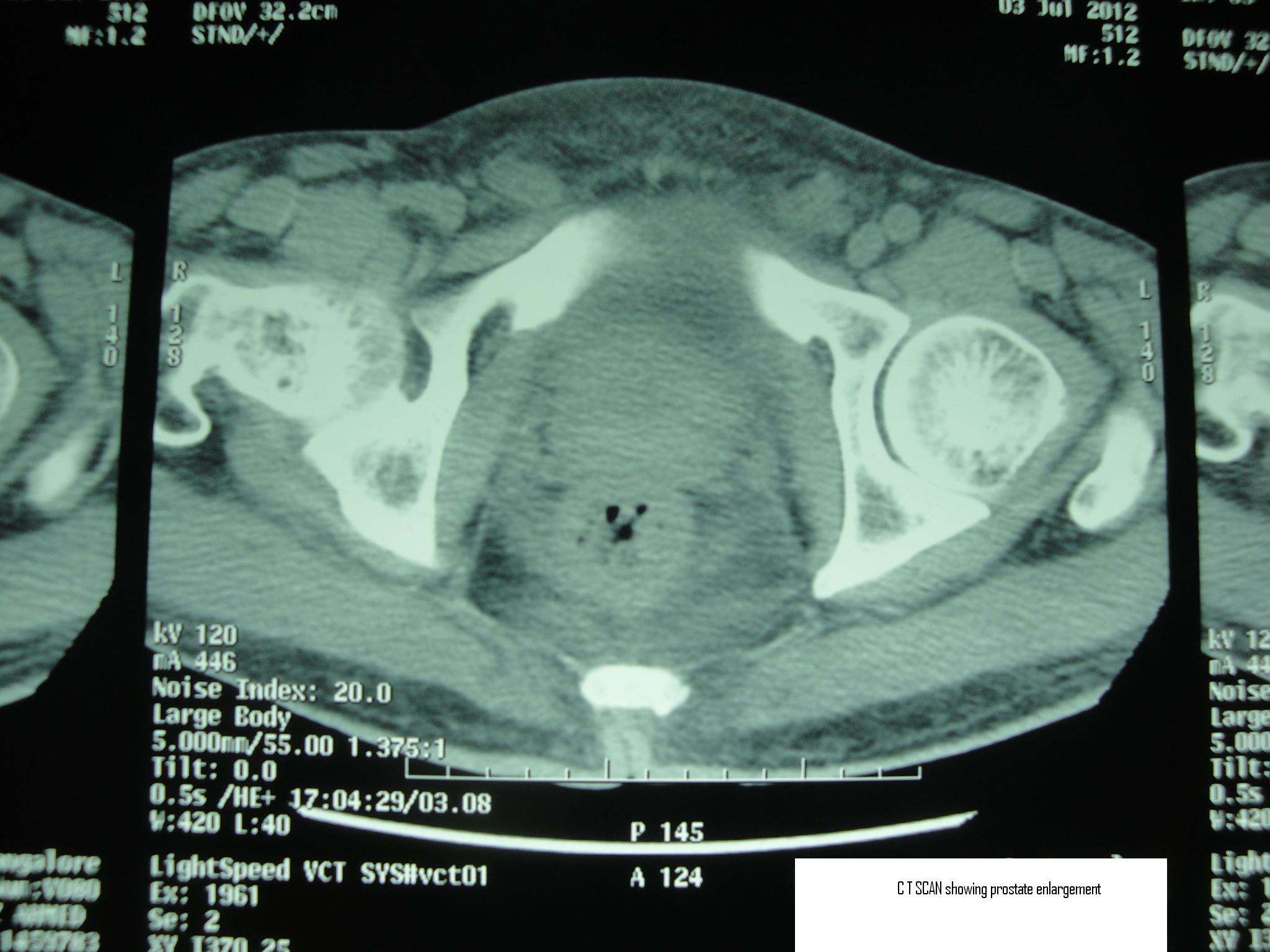 Ct Kub Showing Prostate Enlargement 8441