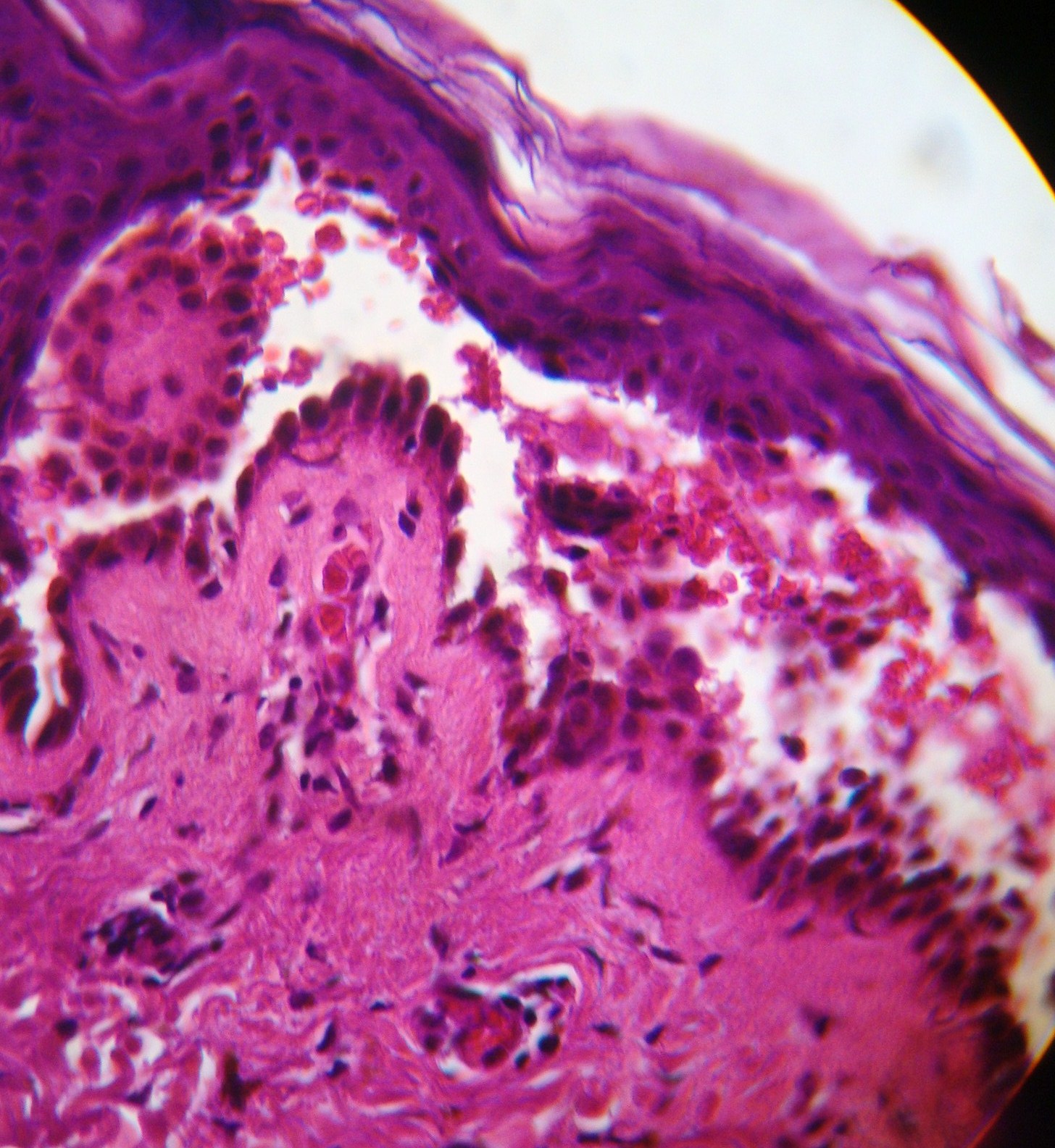 Pemphigus Histology