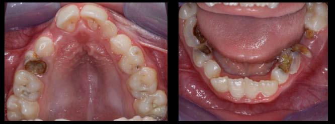 Rubinstein-Taybi syndrome: principal oral and dental disorders and