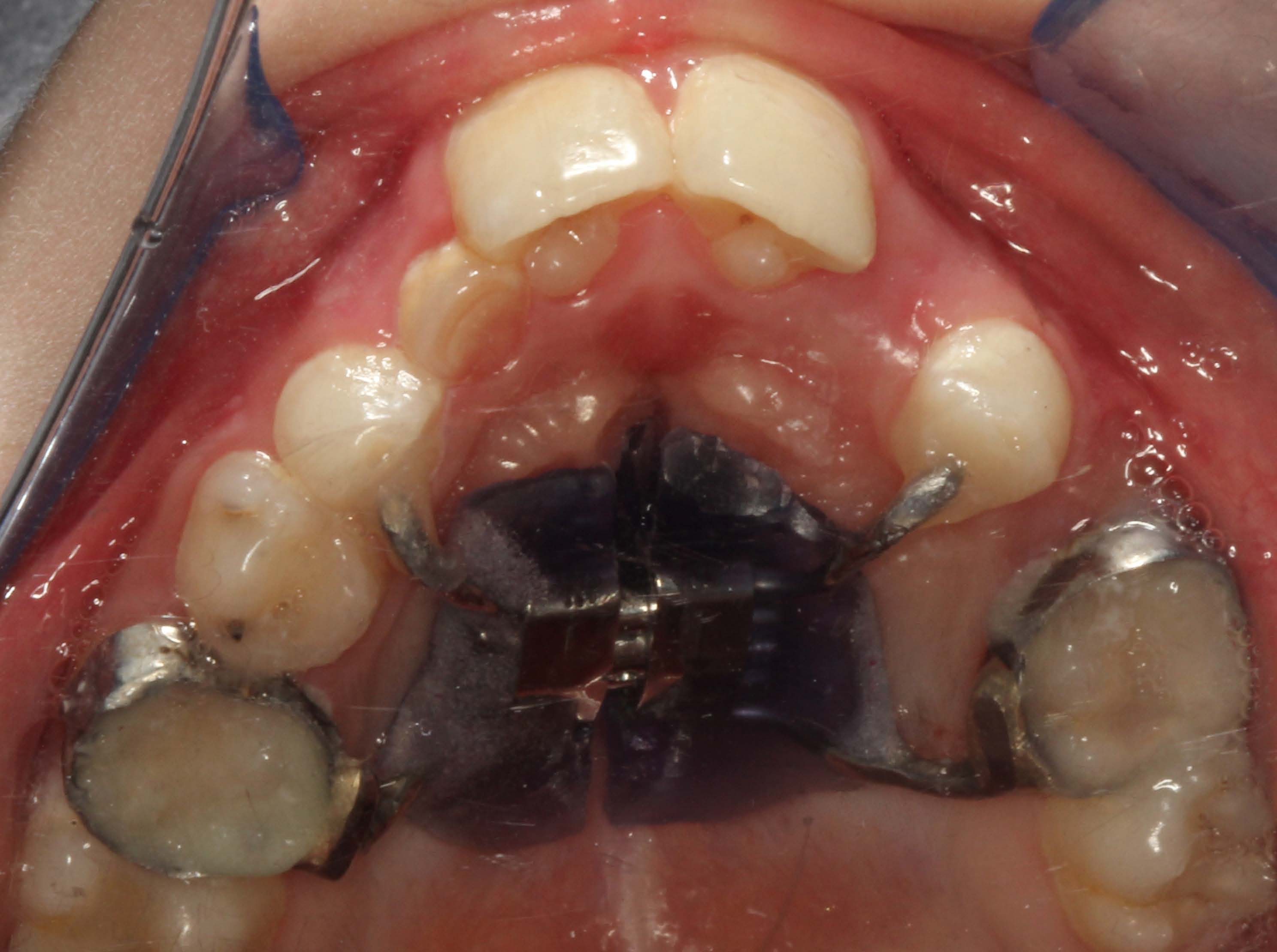 Rubinstein-Taybi syndrome: principal oral and dental disorders and
