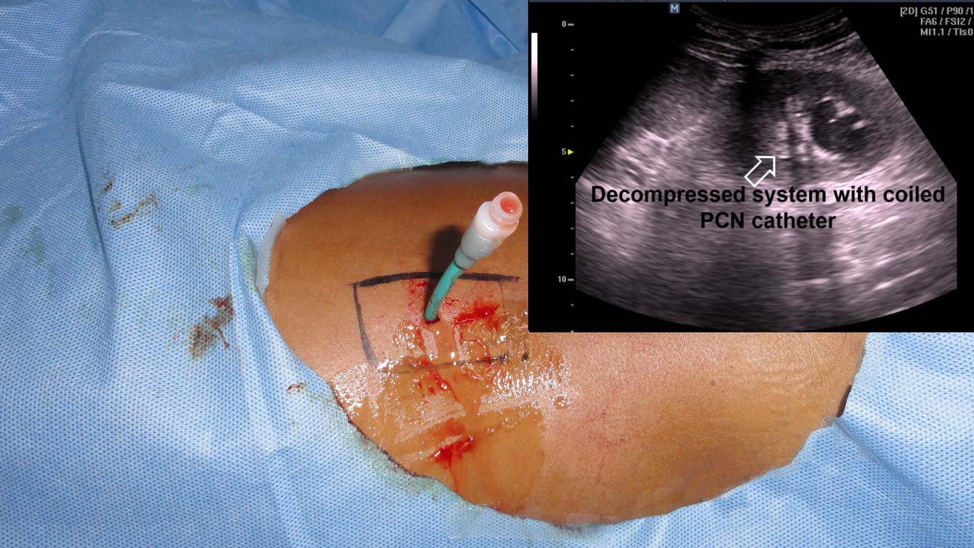 percutaneous nephrostomy