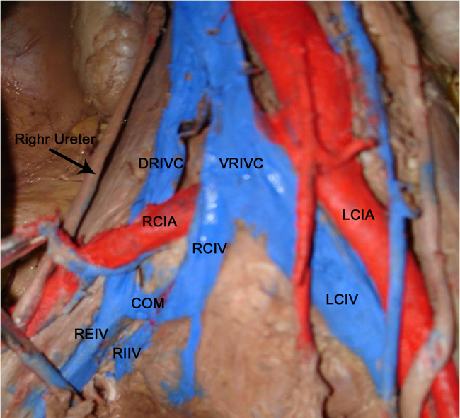 Left Iliac Vein Right Iliac Artery - ovulation symptoms