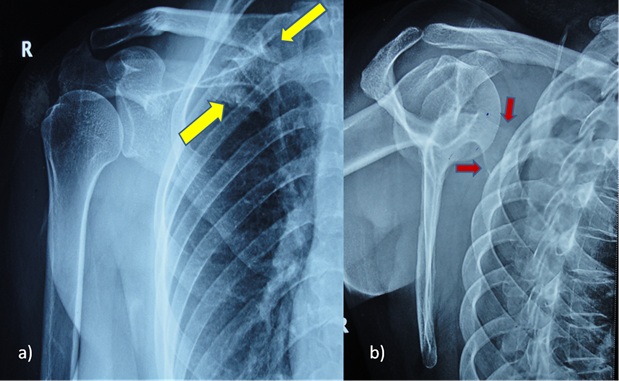 Pre operative MRI defining the boundaries of the tumour mass