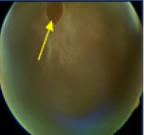 retinal atrophic hole