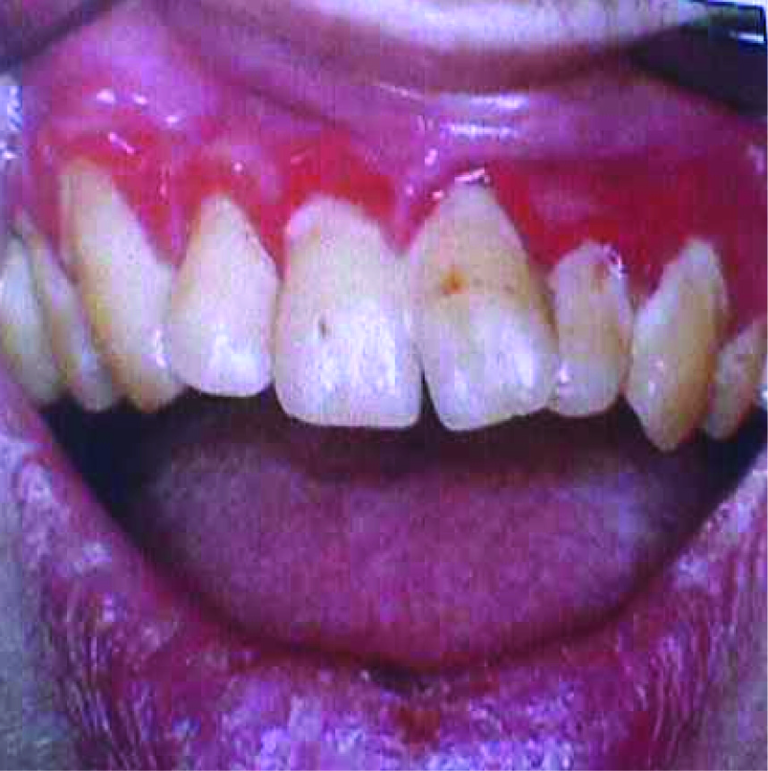 Linear Gingival Erythema