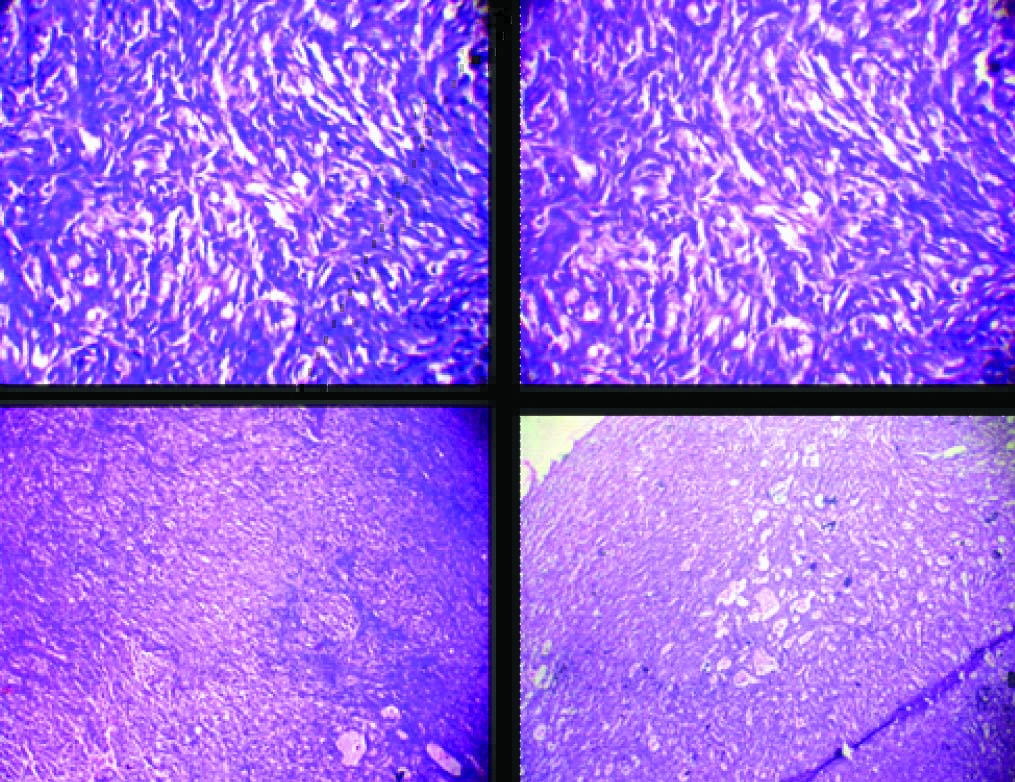 Histological photomicrograph showing cells sheets of spindle cells with ...