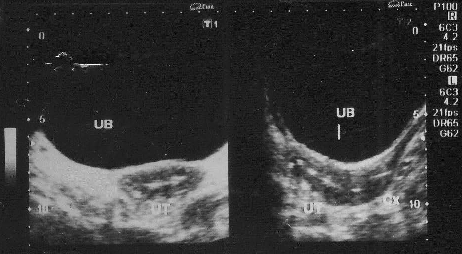 Second ultrasonography showing an in situ IUD - Lippes Loop