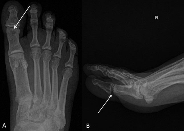 Sesamoid Bone X Ray