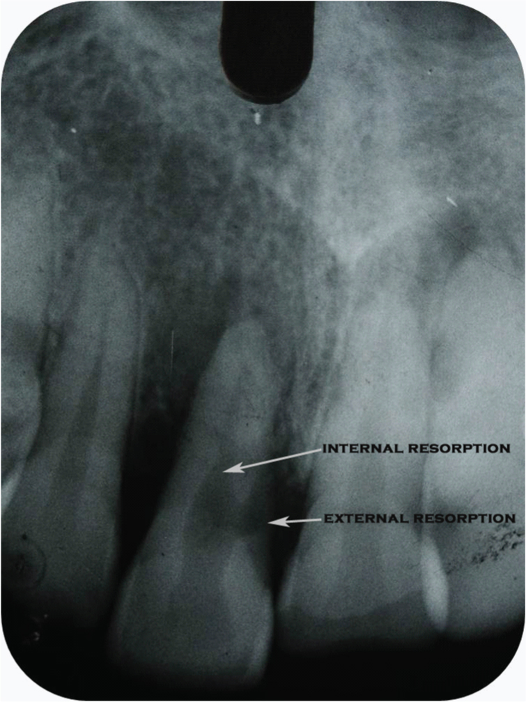 External Resorption Vs Internal Resorption