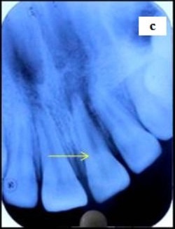 Pulpstone Radiograph Article Fulle Text