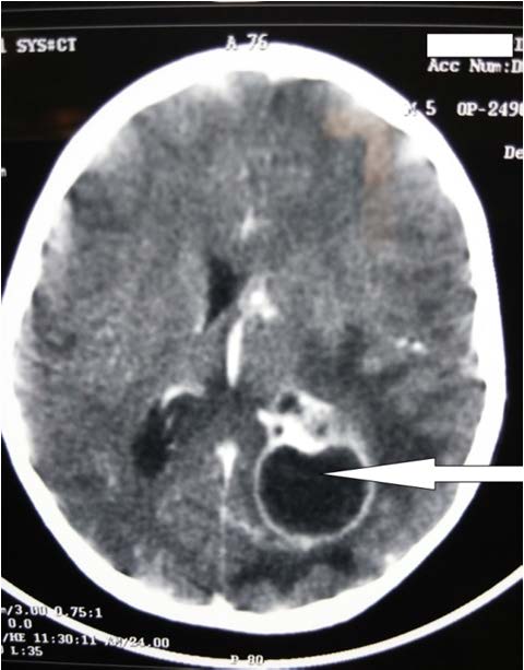 Infratentorial Lesions