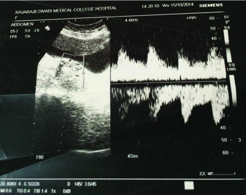 USG showing echogenic solid mass with increased vascularity