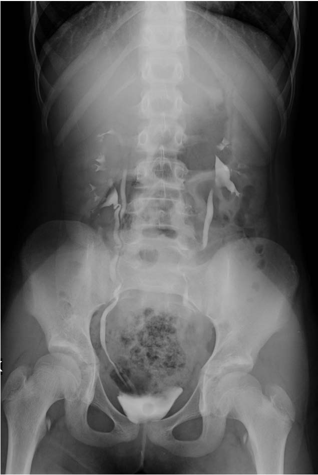 Ureterocele Ivp