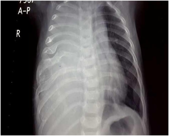 Chest X-ray right lung opacity with distortion of 5 th , 6 th 7 th ribs