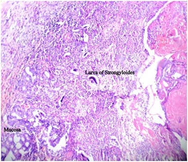 Photomicrograph showing numerous Strongyloidal larva in mucosa and ...