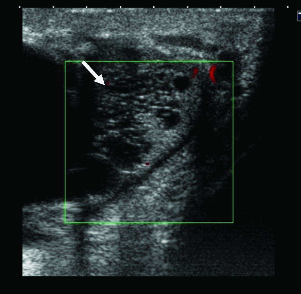 Сперматоцеле лечение. Сперматоцеле яичка УЗИ. Сперматоцеле на УЗИ описание. Сперматоцеле по УЗИ картинки.
