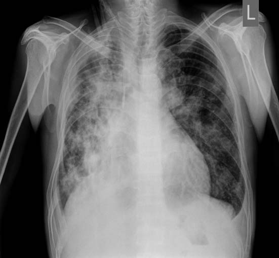 Chest radiograph revealing homogenous opacities in both lungs