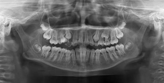 Panoramic Radiograph showing supplemental maxillary central incisor on ...