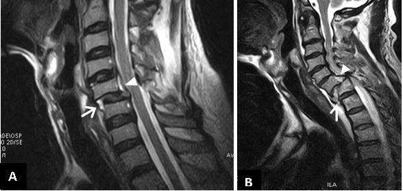 Two other cases of traumatic spondylolisthesis showing a disrupted ...