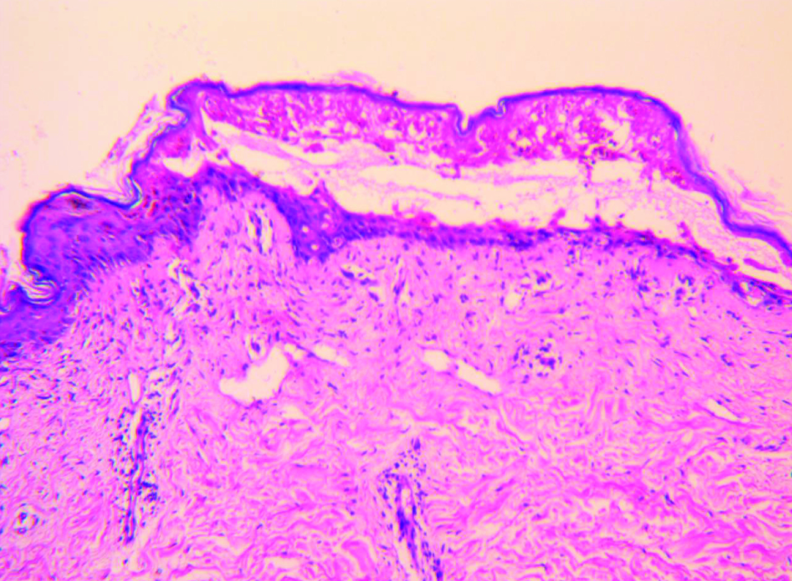 Severity-of-illness assessed by using the SCORTEN criteria