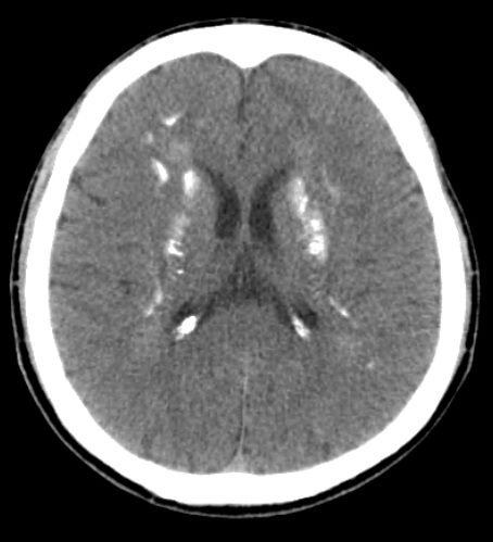 Head computed tomography shows bilateral symmetrical calcifications in ...