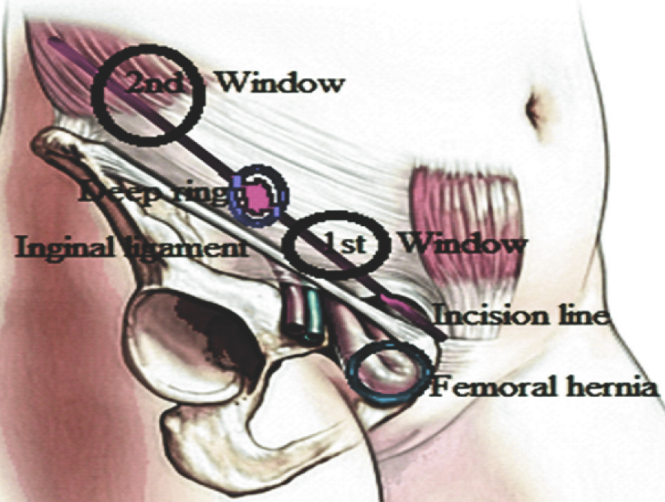 JCDR - Femoral hernia, Gangrenous bowel, Inguinal hernia, One skin  incision, Strangulation, Window