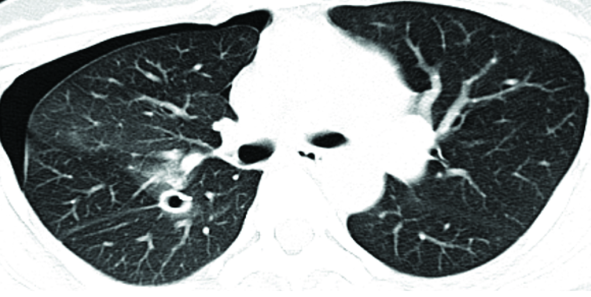 CT ScanRight Pneumothorax with ICD Tube.