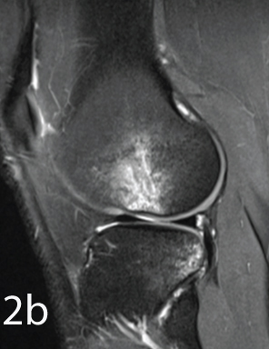 PDFS Coronal: Bone marrow contusion at lateral femoral condyle and ...