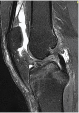 PDFS Saggital: Bone marrow oedema at Medial femoral and Medial tibial ...