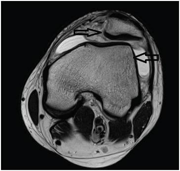 Pattern of marrow oedema as per classification.