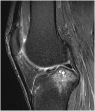 PDFS Coronal: Bone marrow oedema at Medial femoral condyle and proximal ...