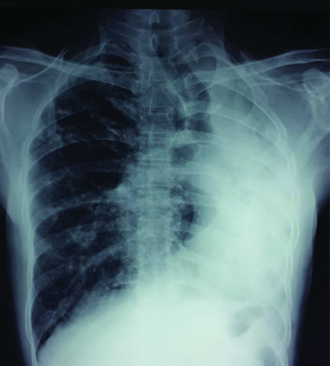 Posteroanterior chest radiograph showing opacification of the left ...