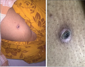 Eschar Examples Showing eschar on the abdomen.