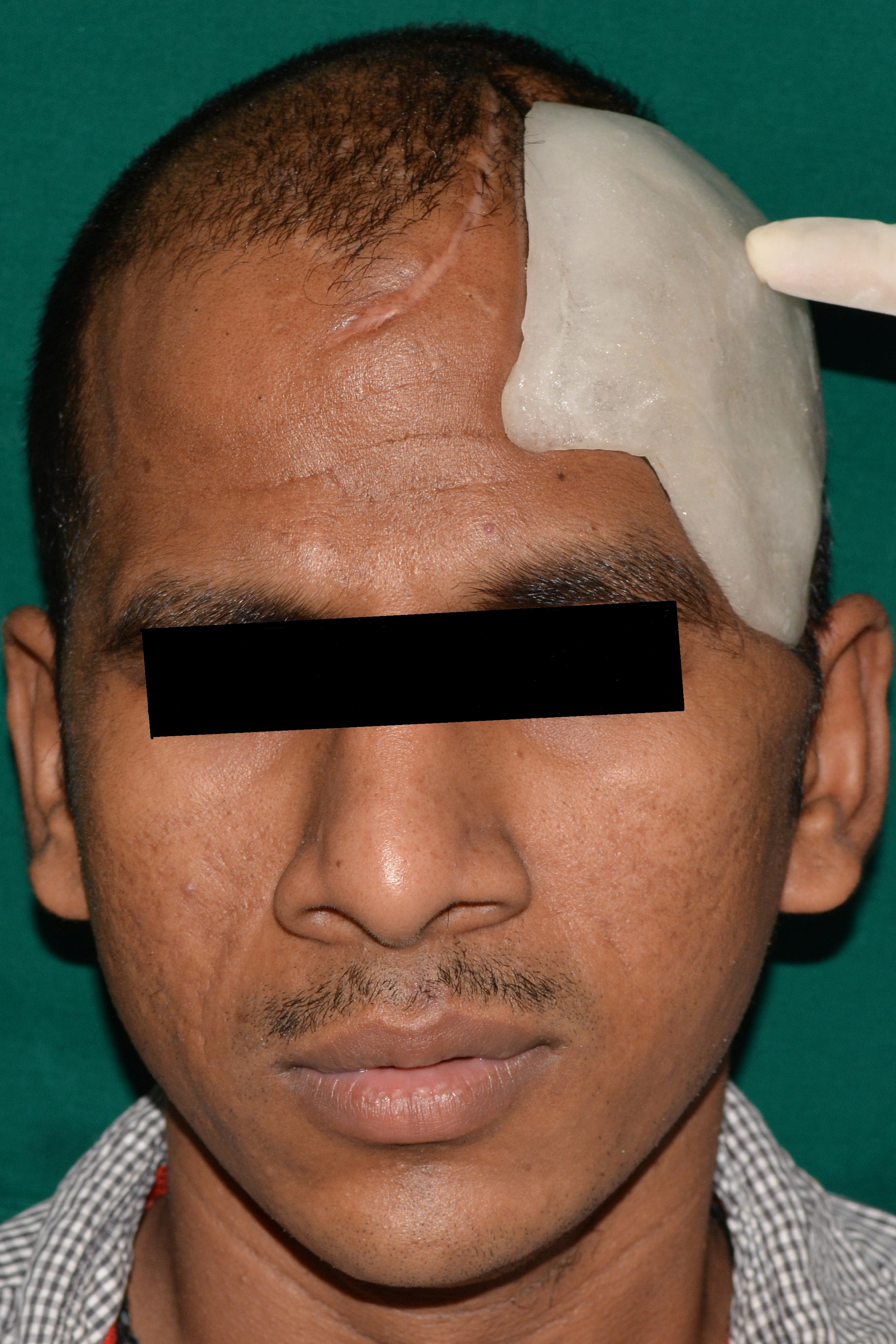 PMMA Implant Tried On The External Surface Of The Cranial Defect.