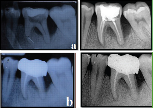Experimental site radiographic assessment - IOPA and RVG