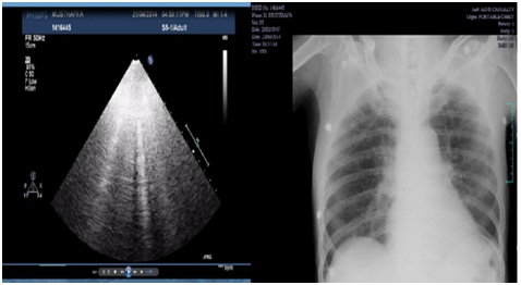 Chest X-ray and lung ultrasound of same patient showing moderate ...