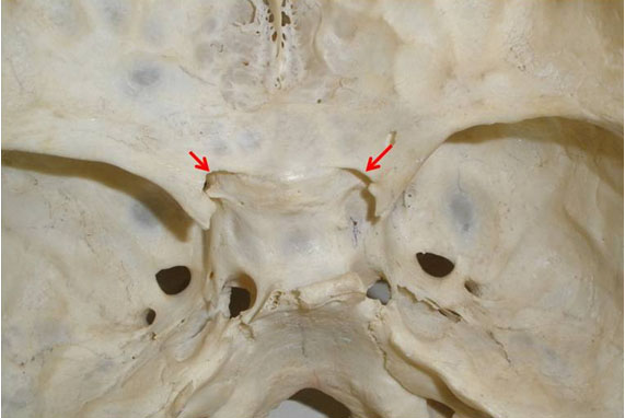 Shows bilateral presence of notches on cranial opening of optic foramen ...