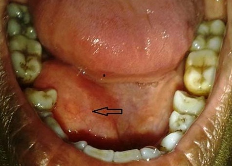 Floor Of Mouth Swelling | Review Home Co