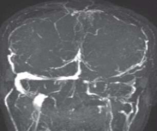 Delta Sign Mri Magnetic Resonance Venogram (MRV) of the patient showing saggital sinus ...