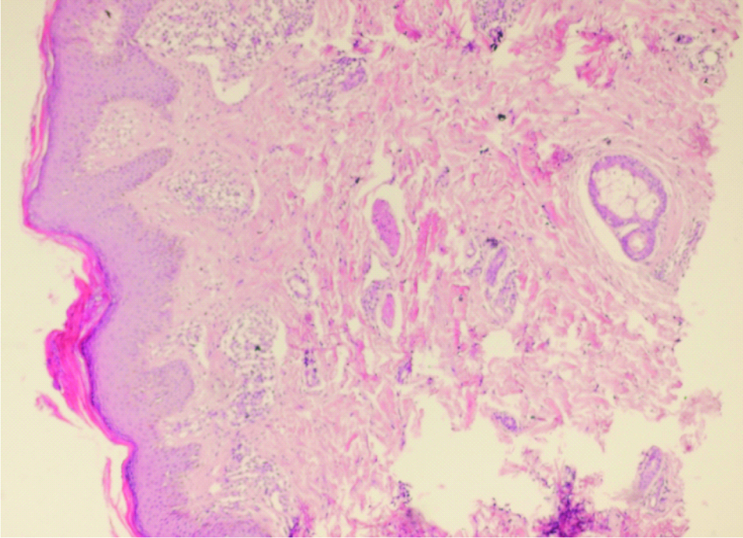 Histologic Picture Skin Tissue Is Seen With Mound Of Parakeratosis