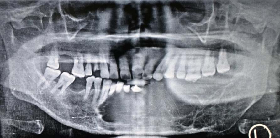 Panoramic radiography showing a diffuse radiolucency on the left side ...