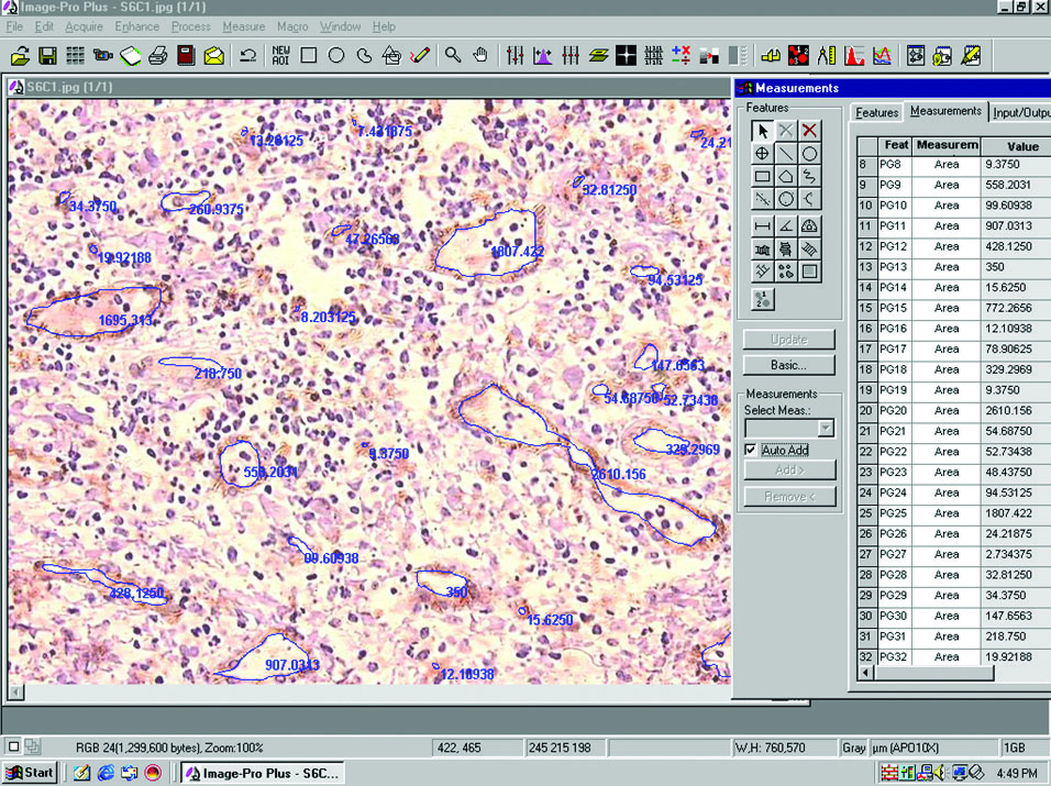 Photomicrograph showing MVA measurement using Image Pro Plus software ...