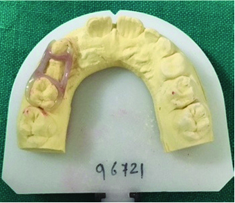BruxZir space maintainer appliance on the dental cast;